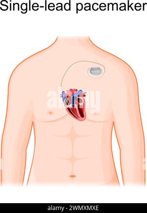 Positionnement d'un stimulateur cardiaque à dérivation unique. Corps humain avec section transversale du coeur et stimulateur cardiaque artificiel. Une seule électrode de stimulation est placée dans un chambe Illustration de Vecteur