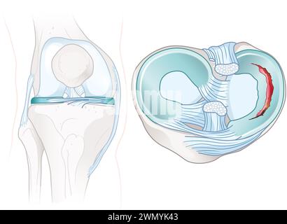 Les ménisques sont des cartilages en forme de C dans les genoux, amortissant et stabilisant les articulations. Les ligaments croisés stabilisent le genou, reliant le cuisse et le tibia. Banque D'Images