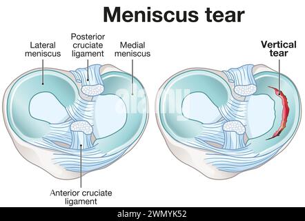 Les ménisques sont des cartilages en forme de C dans les genoux, amortissant et stabilisant les articulations. Les ligaments croisés stabilisent le genou, reliant le cuisse et le tibia. Banque D'Images