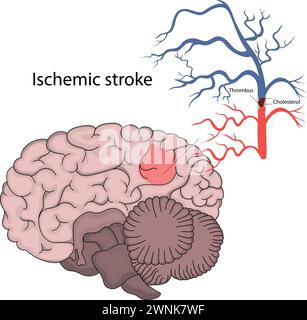 Illustration vectorielle d'un accident vasculaire cérébral ischémique. Infarctus cérébral. Illustration de Vecteur