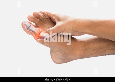 Niveaux élevés d'acide urique dans les os des orteils des hommes sur un fond gris. Banque D'Images