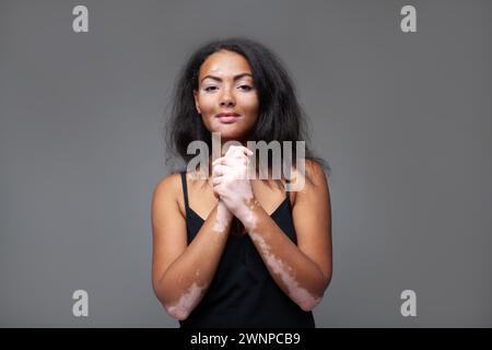 Belle femme africaine heureuse avec la maladie du vitiligo regardant la caméra. Portrait de fille confiante avec les mains serrées debout sur fond gris. Banque D'Images