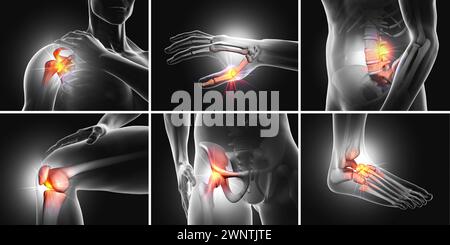 Un ensemble de six articulations douloureuses, illustration médicale 3D Banque D'Images