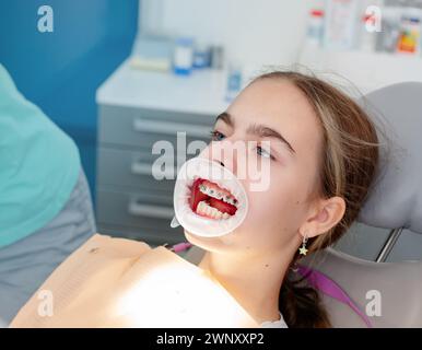 Conception des soins dentaires. Image agrandie de bagues en céramique et en métal sur les dents. Vue rapprochée des mains du dentiste appliquant de la colle bleue sur le bo propre du patient Banque D'Images