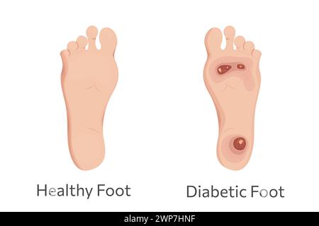 Illustration vectorielle des pieds diabétiques et sains. Diabète et traitement de l'ulcère. Illustration de Vecteur