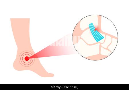 Entorse de la cheville, illustration Banque D'Images