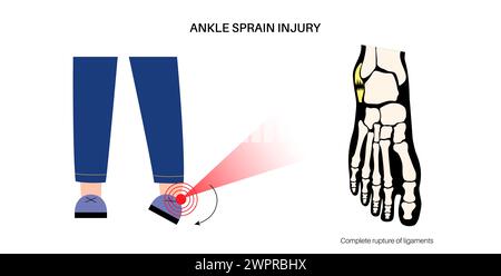 Entorse de la cheville, illustration Banque D'Images