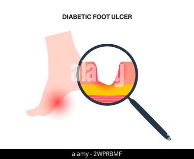 Ulcères du pied diabétique, illustration Banque D'Images
