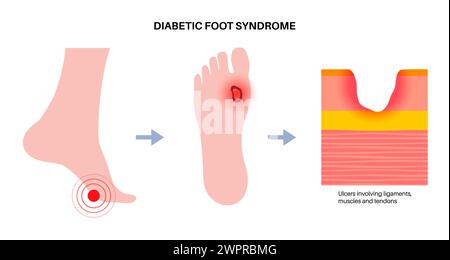 Ulcères du pied diabétique, illustration Banque D'Images