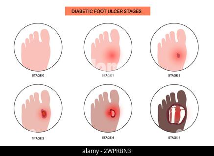 Ulcères du pied diabétique, illustration Banque D'Images