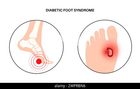 Ulcères du pied diabétique, illustration Banque D'Images