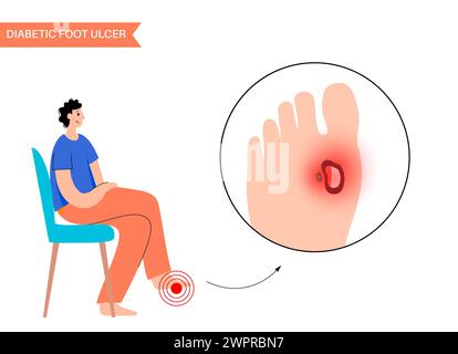 Ulcères du pied diabétique, illustration Banque D'Images