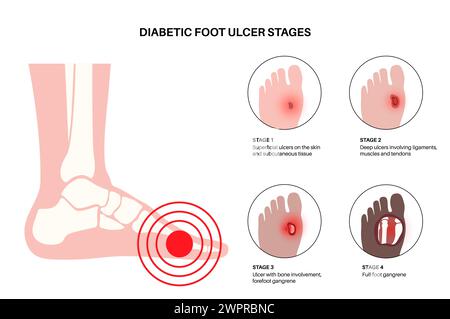 Ulcères du pied diabétique, illustration Banque D'Images