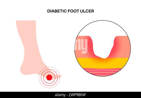 Ulcères du pied diabétique, illustration Banque D'Images