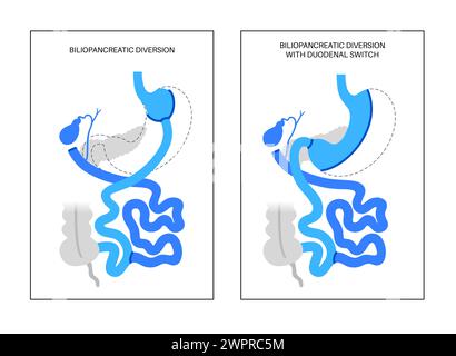 Dérivation biliopancréatique (DBP) avec interrupteur duodénal, illustration. Chirurgie gastrique du DBP, procédure gastrique de perte de poids. Organes internes avant et arrière Banque D'Images