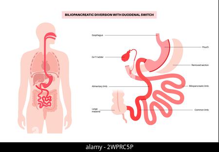 Dérivation biliopancréatique (DBP) avec interrupteur duodénal, illustration. Intervention gastrique pour perte de poids. Banque D'Images