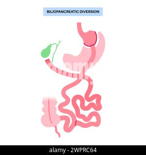 Procédure de dérivation biliopancréatique, illustration Banque D'Images