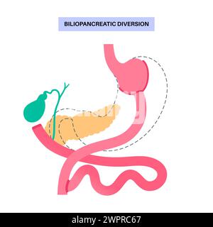 Gastroplastie de dérivation biliopancréatique (DBP), illustration. Intervention gastrique pour perte de poids. Banque D'Images