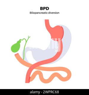 Gastroplastie de dérivation biliopancréatique (DBP), illustration. Intervention gastrique pour perte de poids. Banque D'Images