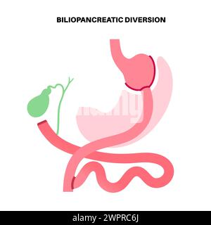 Gastroplastie de dérivation biliopancréatique (DBP), illustration. Intervention gastrique pour perte de poids. Banque D'Images