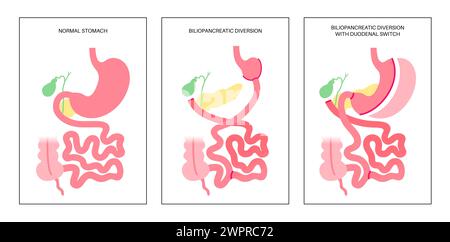 Dérivation biliopancréatique (DBP) avec interrupteur duodénal, illustration. Chirurgie gastrique du DBP, procédure gastrique de perte de poids. Organes internes avant et arrière Banque D'Images