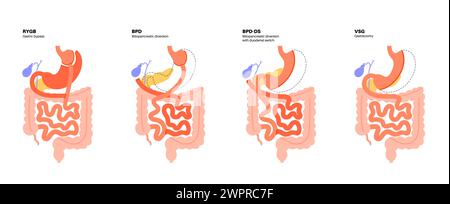 Types de chirurgie bariatrique, illustration Banque D'Images