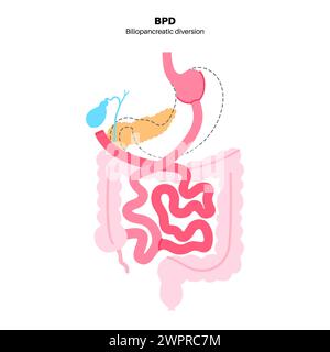 Procédure de dérivation biliopancréatique, illustration Banque D'Images