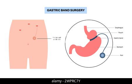 Procédure médicale de bande gastrique, illustration Banque D'Images