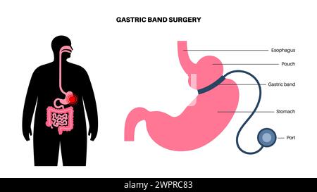 Procédure médicale de bande gastrique, illustration Banque D'Images