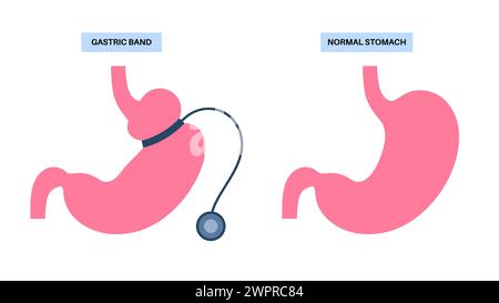 Procédure médicale de bande gastrique, illustration Banque D'Images