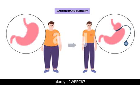 Procédure médicale de bande gastrique, illustration Banque D'Images