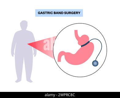 Procédure médicale de bande gastrique, illustration Banque D'Images