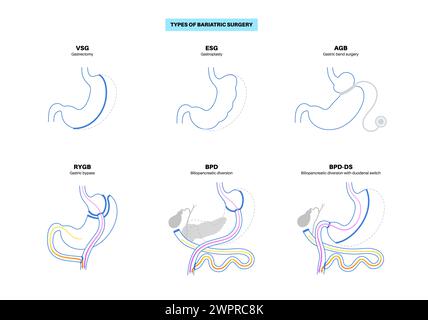 Types de chirurgie bariatrique, illustration Banque D'Images