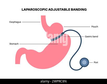 Procédure médicale de bande gastrique, illustration Banque D'Images