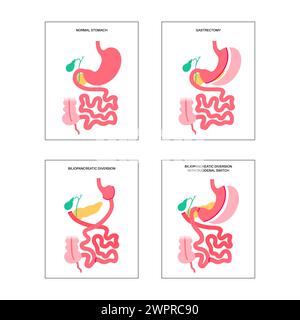 Types de chirurgie bariatrique, illustration Banque D'Images