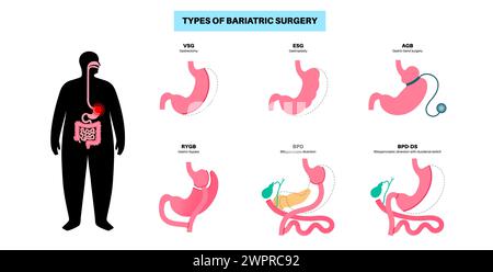 Types de chirurgie bariatrique, illustration Banque D'Images