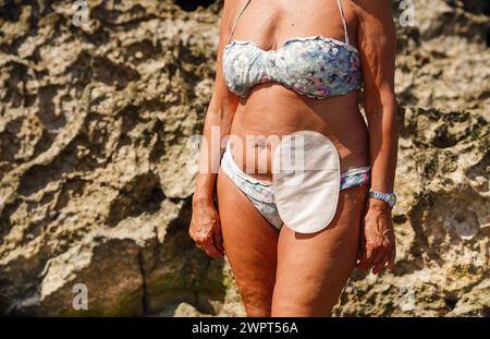 femme méconnaissable avec un sac de stomie sur la plage. Résilience après cancer colique Banque D'Images