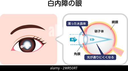 Causes et mécanisme de l'illustration vectorielle de la cataracte Illustration de Vecteur