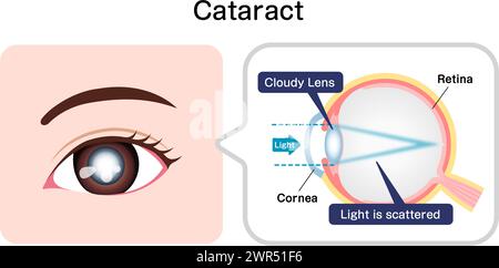 Causes et mécanisme de l'illustration vectorielle de la cataracte Illustration de Vecteur