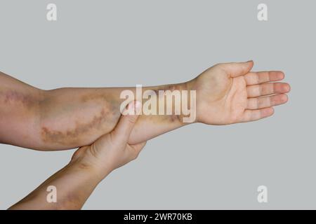 Main féminine avec ecchymose d'accident de voiture Banque D'Images