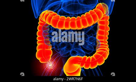 anatomie de la douleur de l'appendice pour concept médical illustration 3d. Banque D'Images