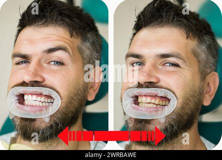 Dents jaune vs blanc, avant ou après le blanchiment. Homme avec un arrière-plan isolé touchant la bouche avec une expression douloureuse à cause de maux de dents ou dentaires Banque D'Images