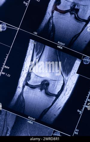 Examen IRM radiographique images de résonance magnétique montrant une fracture réelle du genou après blessure tonalité bleue Banque D'Images