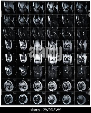 Examen IRM radiographique images par résonance magnétique montrant une fracture réelle du genou après traumatisme Banque D'Images