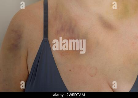Corps féminin avec ecchymose d'accident de voiture Banque D'Images