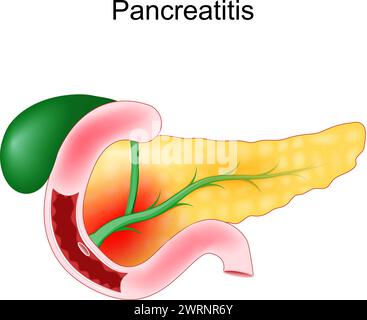 Pancréatites aiguës. Inflammation du pancréas. Illustration vectorielle réaliste d'un duodénum, vésicule biliaire et pancréas. Illustration de Vecteur