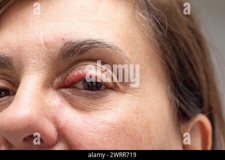 Image détaillée du visage d'une femme avec un œil rouge infecté Banque D'Images