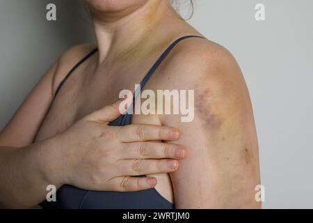 Épaule féminine avec ecchymose d'accident de voiture Banque D'Images