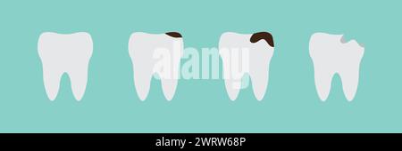 Dents aux différents stades de la carie. Carie dentaire, mal de dents. Caries profondes et chaires. Illustration vectorielle de style plat isolée Illustration de Vecteur