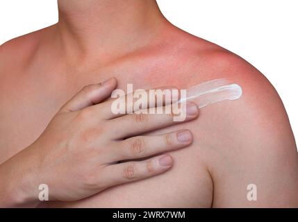 Un homme avec la peau rougie et qui démange après un coup de soleil applique une crème sur l'épaule. Soin de la peau et protection contre les rayons ultraviolets du soleil. Banque D'Images